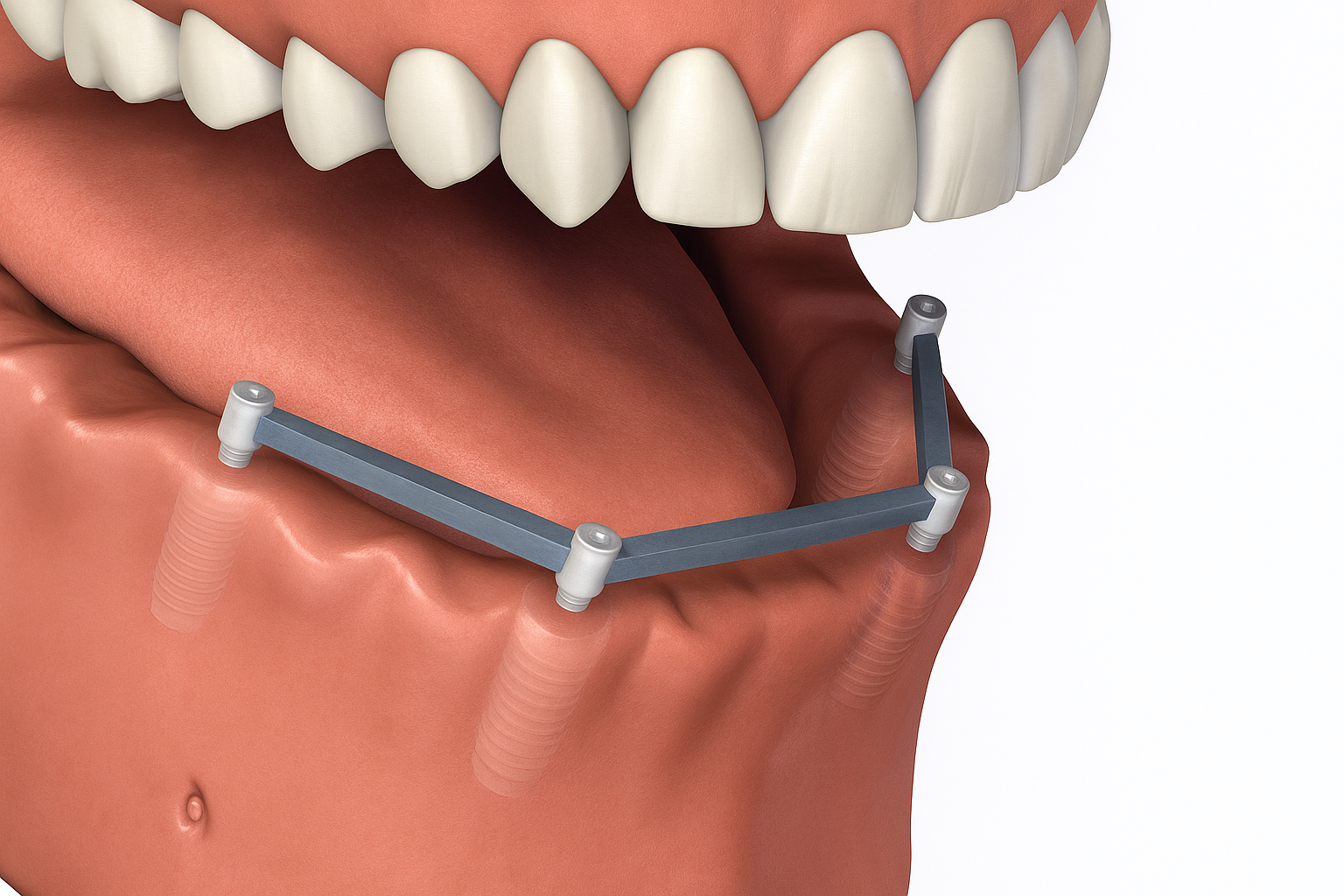 A mouth without teeth and four implants connected by a metal bar on its lower jaw
